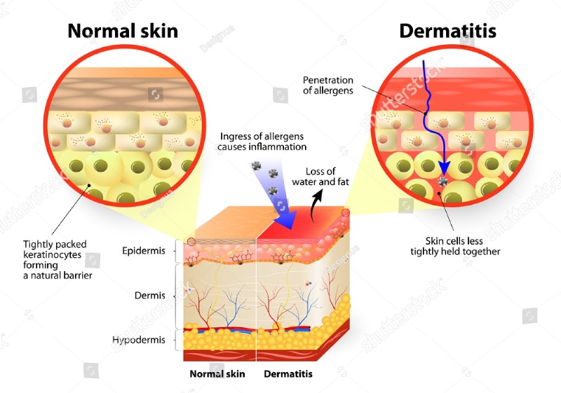 Therapeutic effects on atopic dermatitis are demonstrated with local applications of hyaluronan at high (but not low) molecular weights 